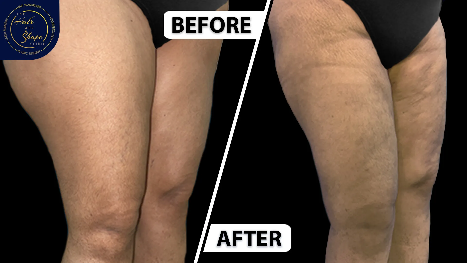 Thigh Liposuction result6